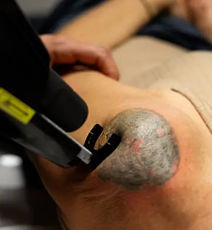 Eliminación de tatuajes con láser en Huancayo
